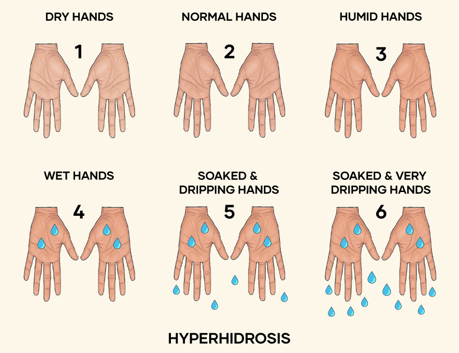 Illustration of Hyperhidrosis
