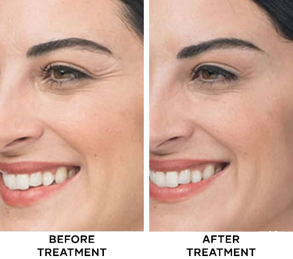 Crow's Feet Botox treatment results at Cocoon Medical Spa