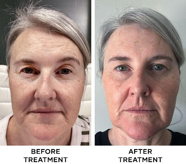 Crow's Feet Botox results in Bali