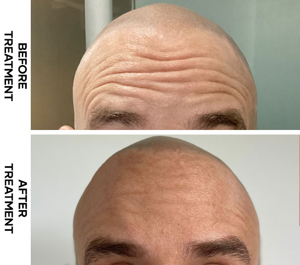 Frown Line Botox results in Bali