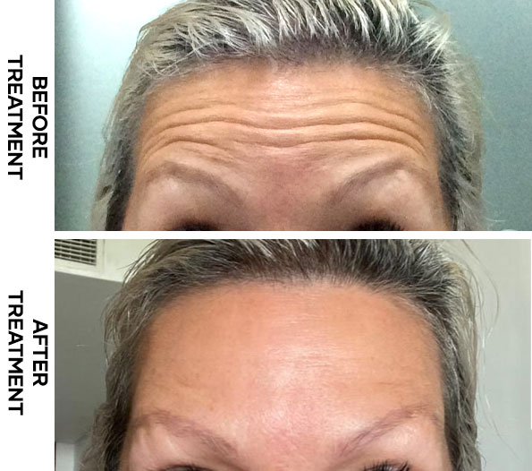 Frown Line Botox results in Bali