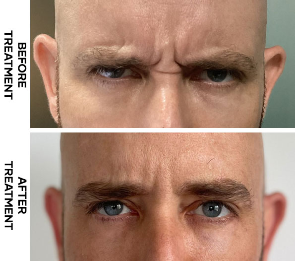 Frown Line Botox results in Bali