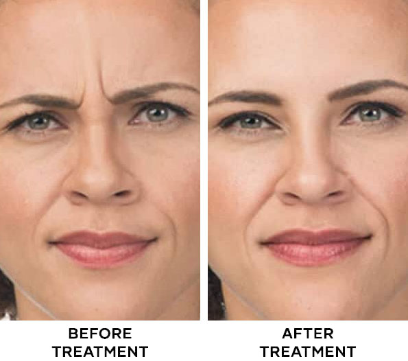 Frown Line Botox results in Bali
