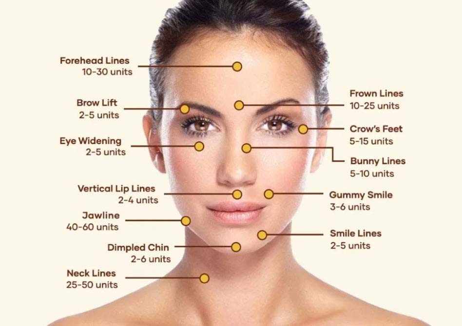 Botox applications points