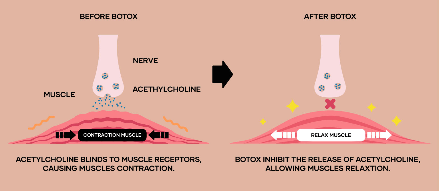 How Botox work Before AFter botox - relaxation muscle