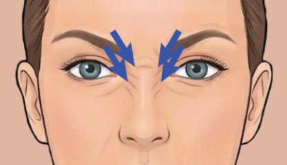 Illustration showing bunny lines Botox treatment areas