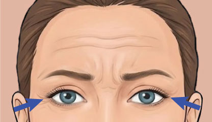 Illustration showing forehead Botox Crow's Feet treatment areas