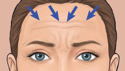 Illustration showing forehead Botox treatment areas