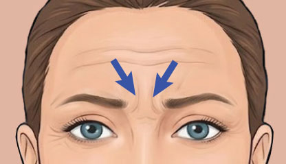 Illustration showing forehead Botox Frown Lines treatment areas
