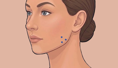 Injections points for Bruxism & Teeth Grinding