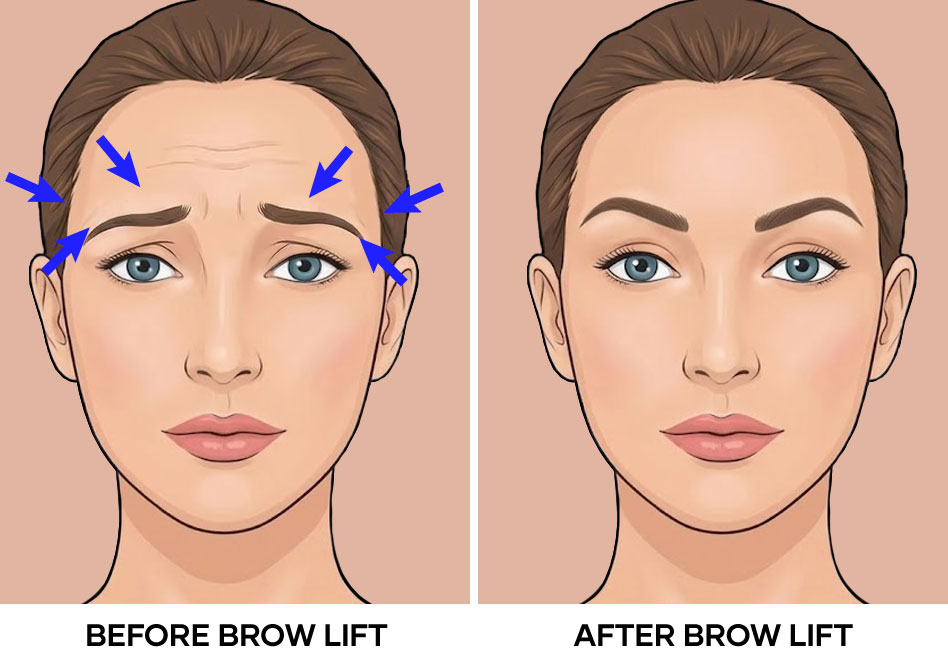 Illustration of brow lift before and after