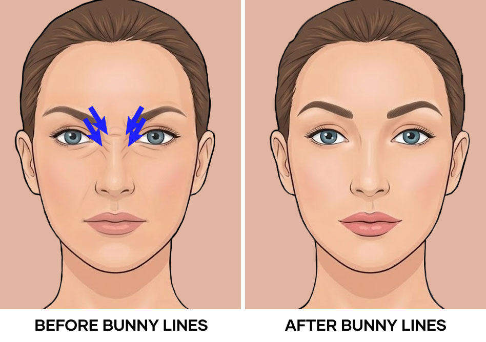 Illustration of bunny lines before and after