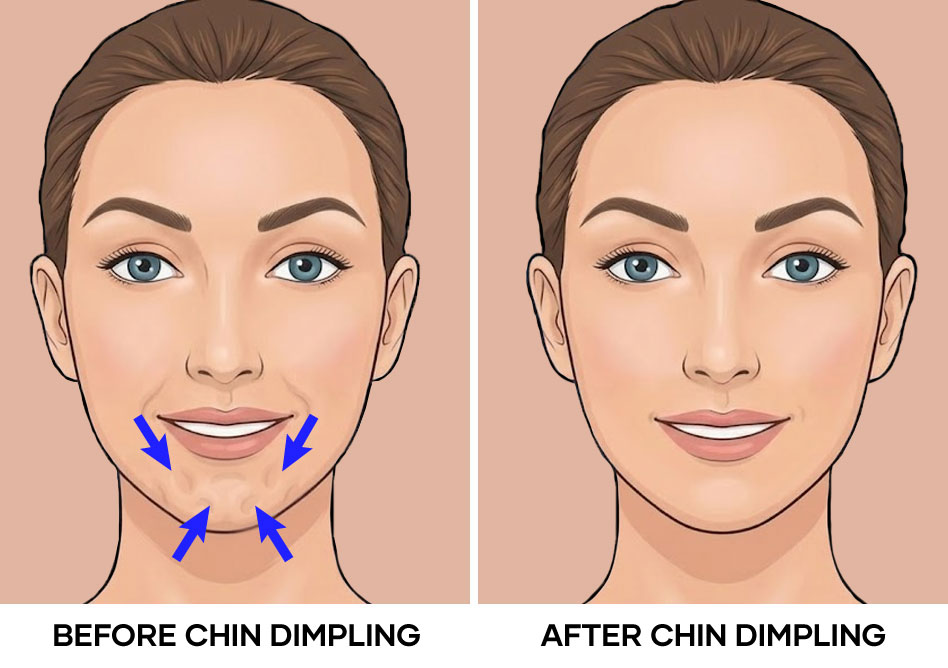 Illustration of chin dimpling before and after