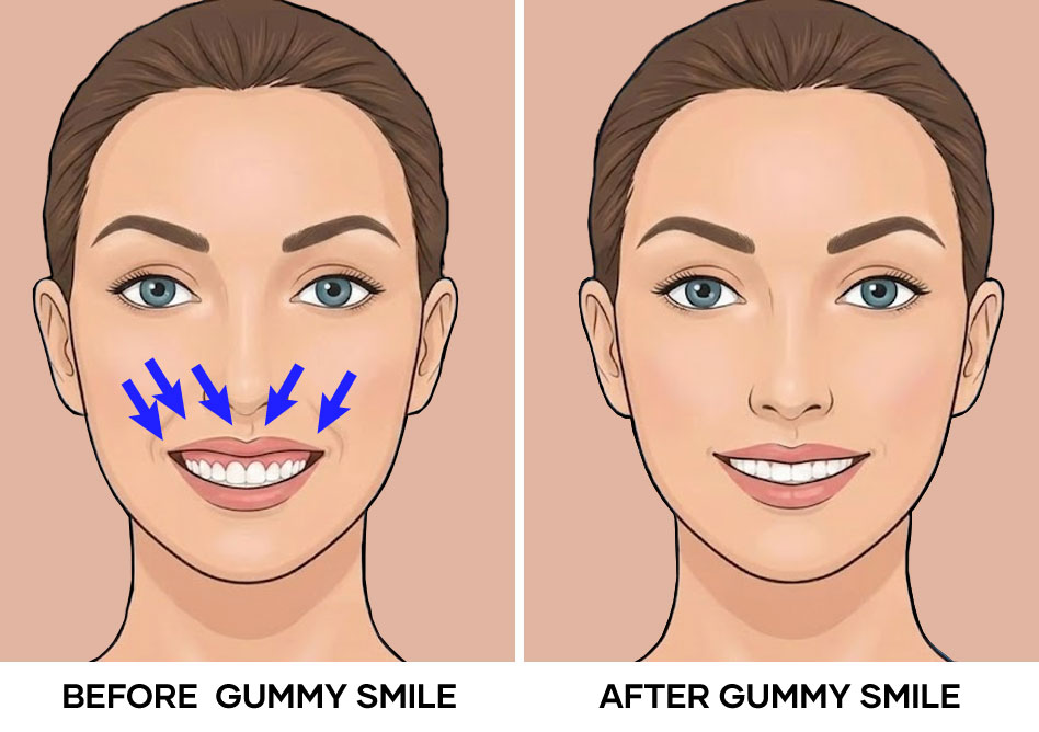 Illustration of gummy smile before and after