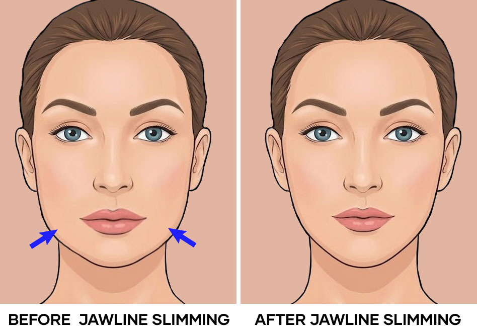 Illustration of jaw lines slimming before and after