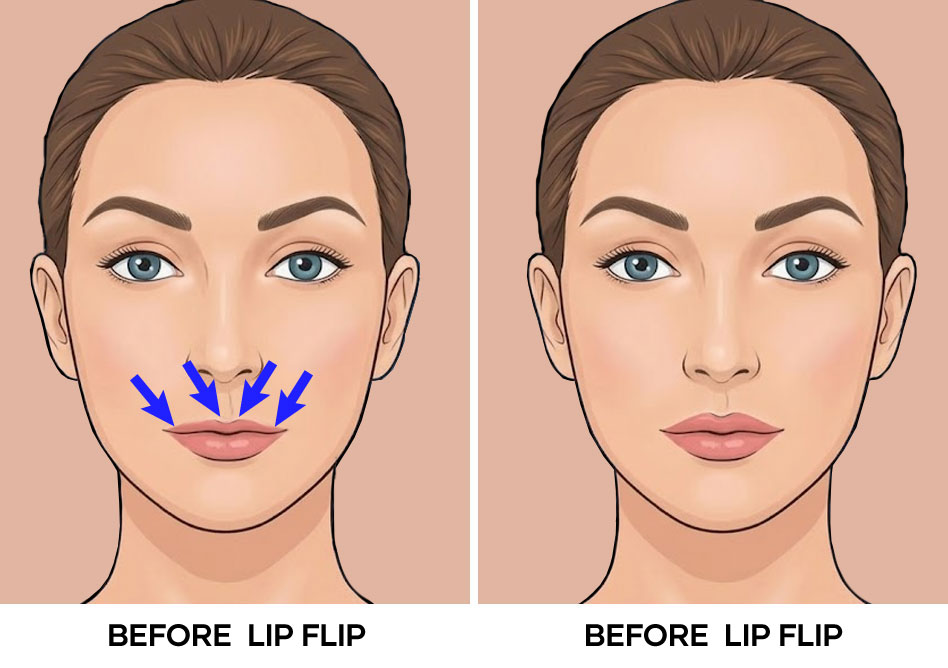 Illustration of lip flip before and after