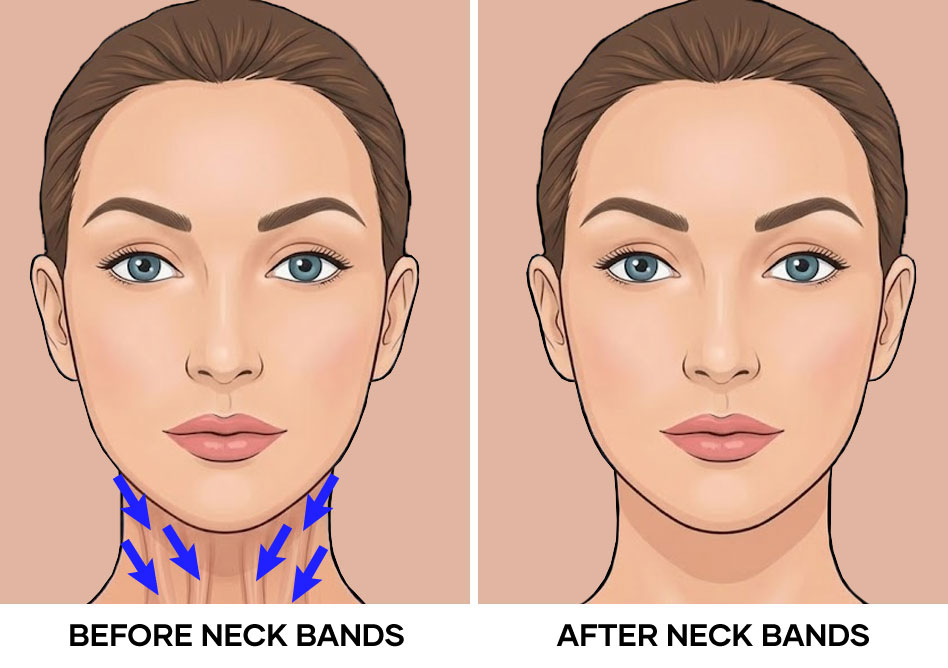 Illustration of neck bands before and after