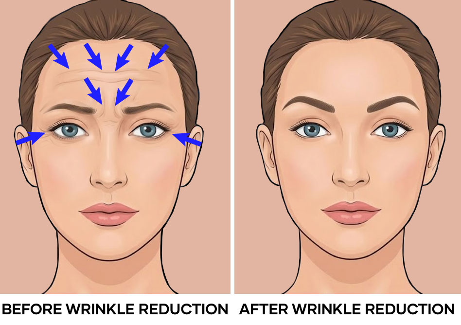 Illustration of wrinkle reduction before and after