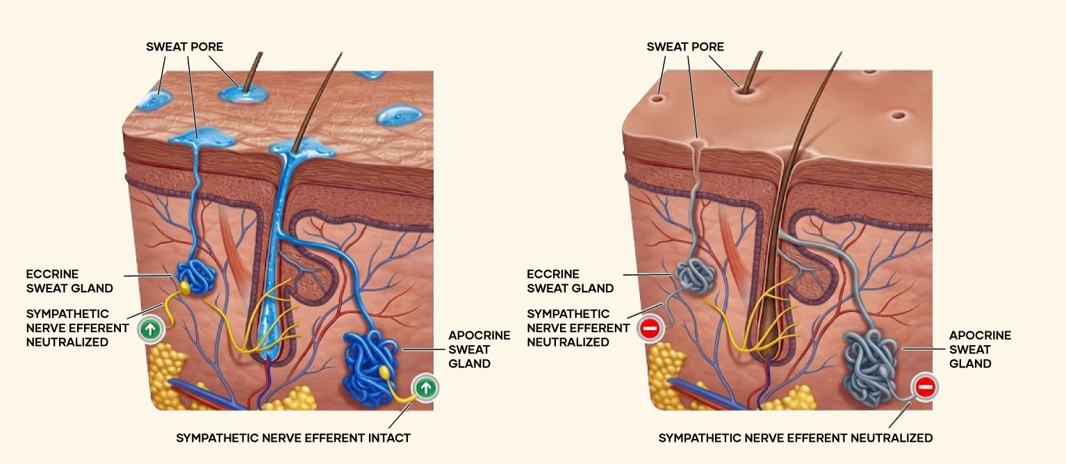 Illustration of sweat gland before and after botox