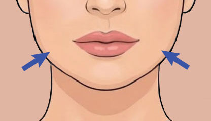 Illustration showing Jawline Slimming Botox treatment areas